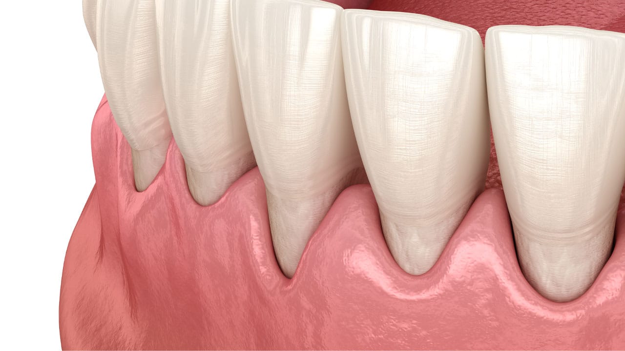 Receding Gums